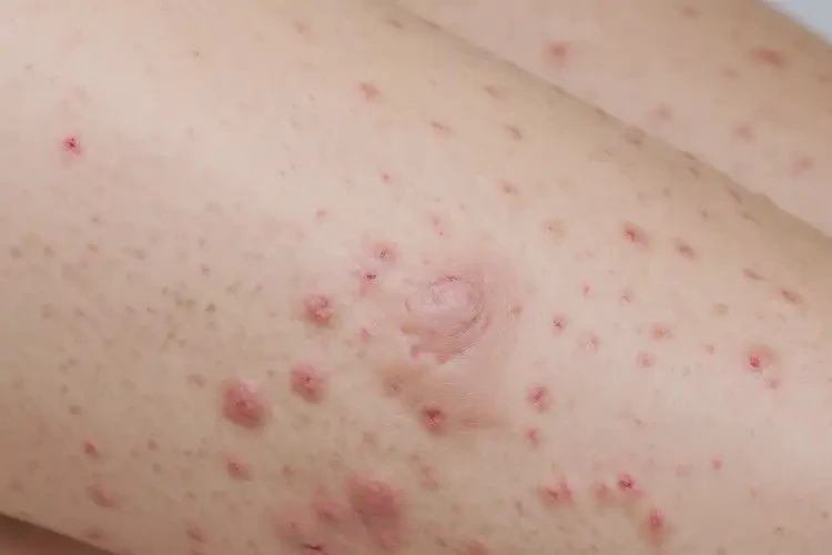 产妇大腿上长湿疹能治好吗(图4)