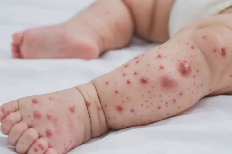 幼儿四肢经常长湿疹可以彻底自愈吗(图4)