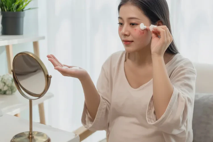 产妇面部偶尔长湿疹可以治愈吗(图2)