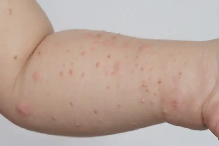 孩子手上起湿疹能治好吗(图3)