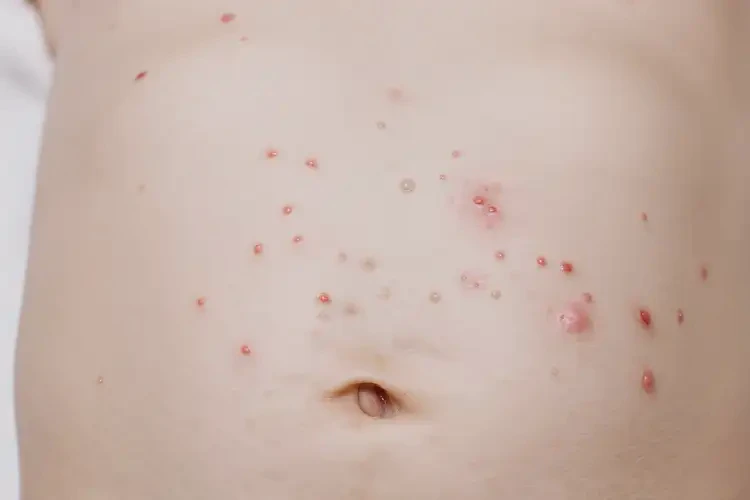 婴幼儿肚子上容易起湿疹能治好吗(图4)