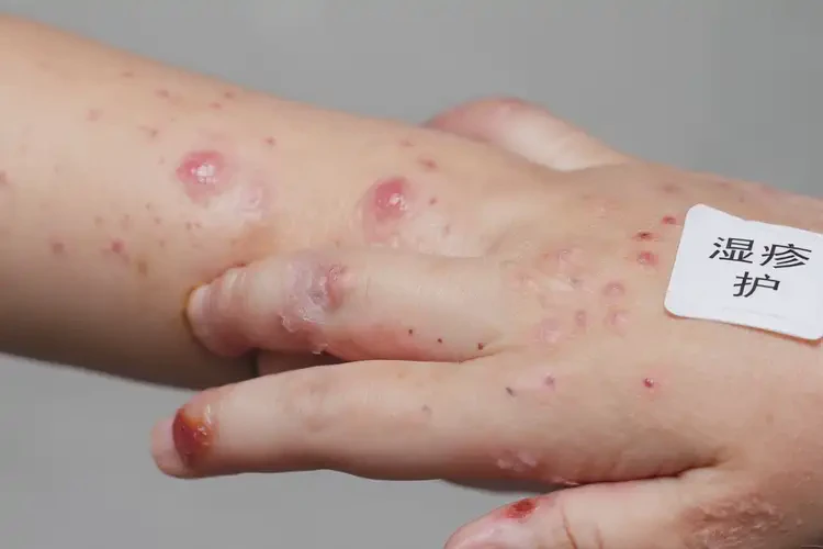少儿手上出现湿疹能治好吗(图3)