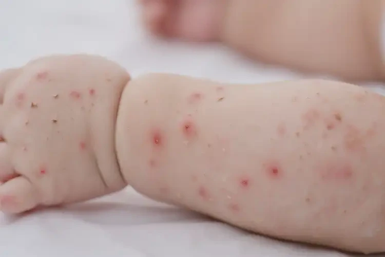 小儿四肢出湿疹能治好吗(图4)