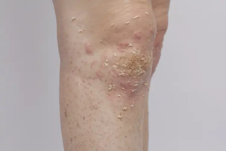 女性小腿出现湿疹能治好吗(图3)