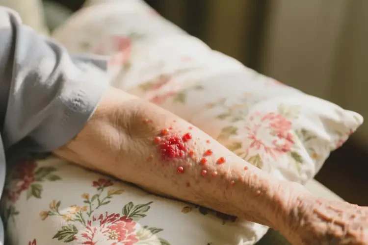 老人四肢出湿疹能治好吗(图1)