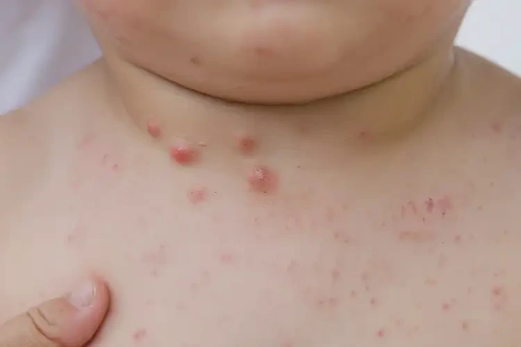 孩子脖子上偶尔长湿疹能治好吗(图3)