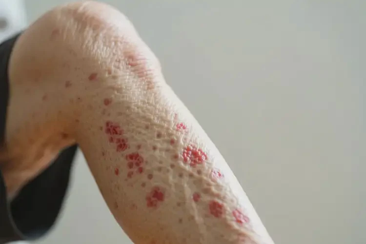 老人小腿出现湿疹能治好吗(图4)