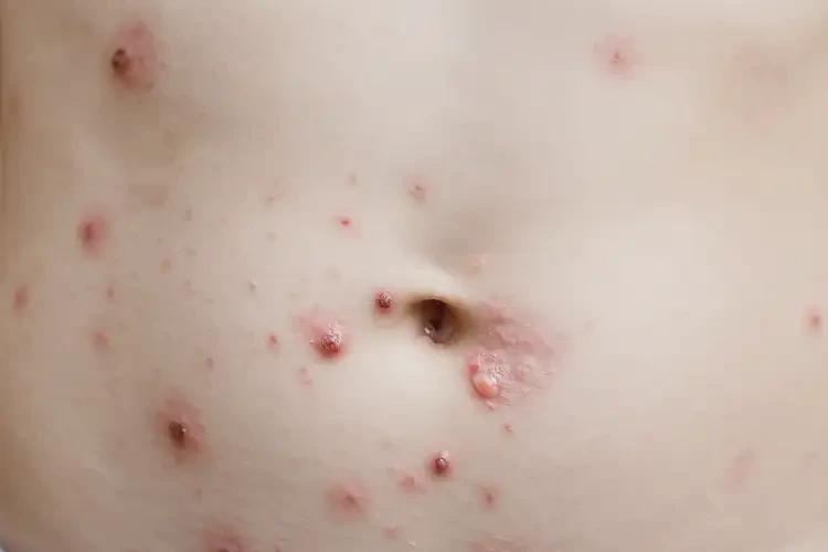 儿童肚子起湿疹能治好吗(图4)