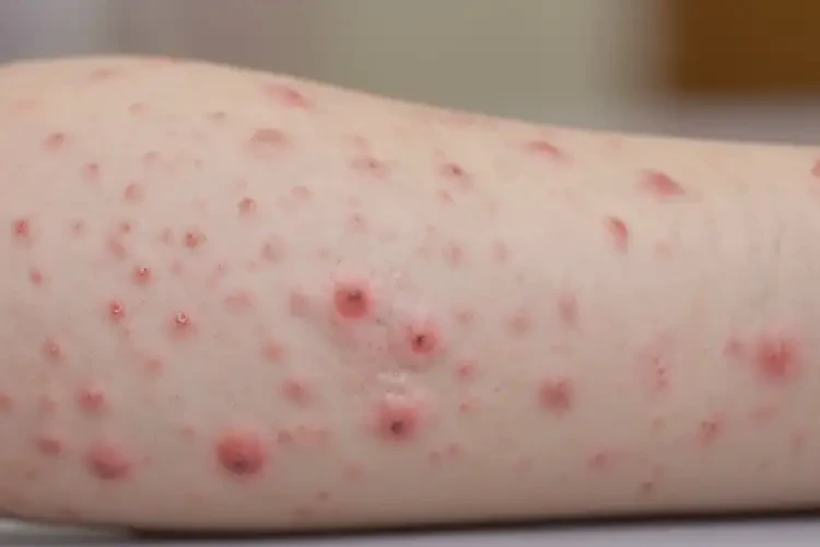 小孩身上容易起湿疹能治好吗(图3)