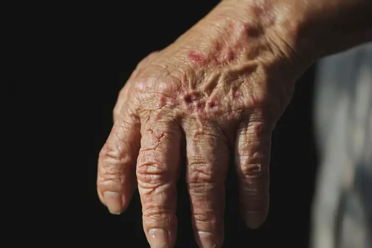 老年人手上容易起湿疹能治好吗(图4)
