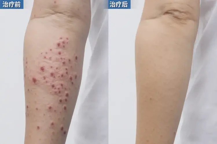 产妇手臂经常起湿疹能治好吗(图4)