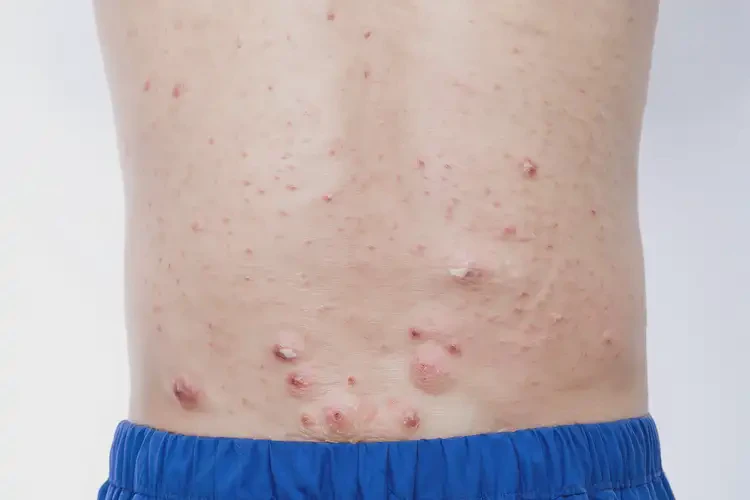 男性屁股上偶尔长湿疹能治好吗(图2)