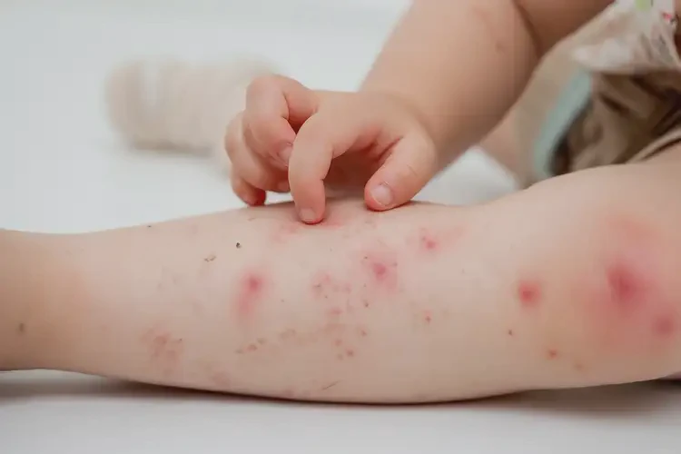 小孩大腿容易起湿疹能治好吗(图3)