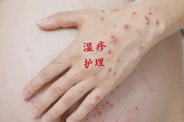 孕妇手上长湿疹不管它会自己痊愈吗(图4)