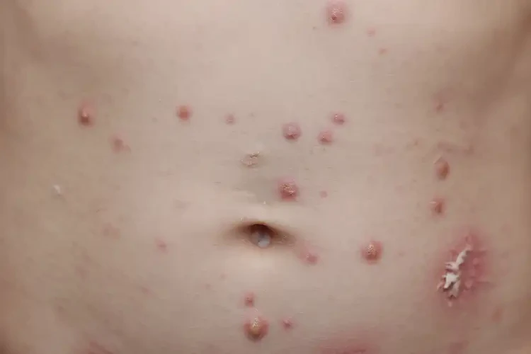 小孩肚子上经常起湿疹能治好吗(图4)