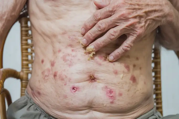 老年人肚子上容易起湿疹能治好吗(图3)