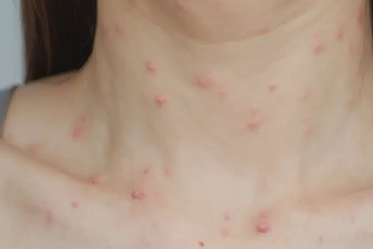 女生脖子偶尔起湿疹可以彻底自愈吗(图4)