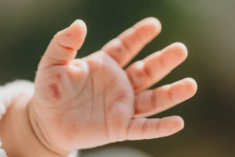 婴儿身上有湿疹能治好吗(图4)