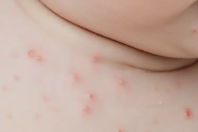 婴儿脖子上出湿疹可以彻底自愈吗(图4)