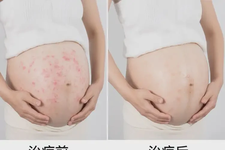 孕妇身上偶尔起湿疹能治好吗(图4)