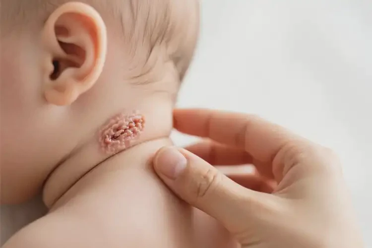 婴幼儿脖子上起湿疹能治好吗(图3)
