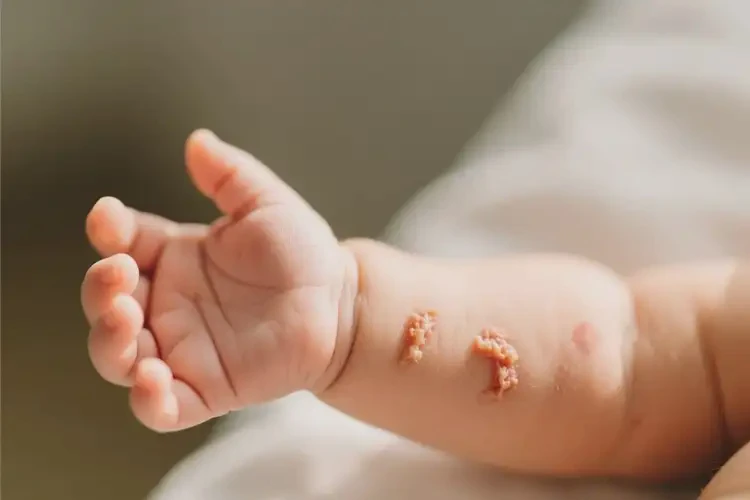 婴儿手臂上起湿疹能治好吗(图4)