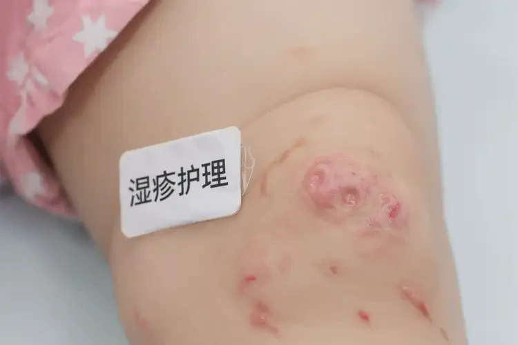 孩子小腿上出湿疹能治好吗(图4)