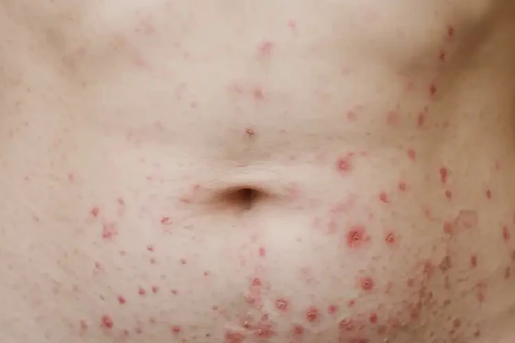 女性肚子容易长湿疹能靠自己自愈吗(图4)