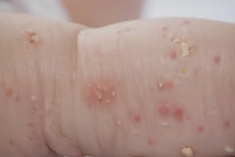 婴幼儿小腿经常起湿疹能治好吗(图4)