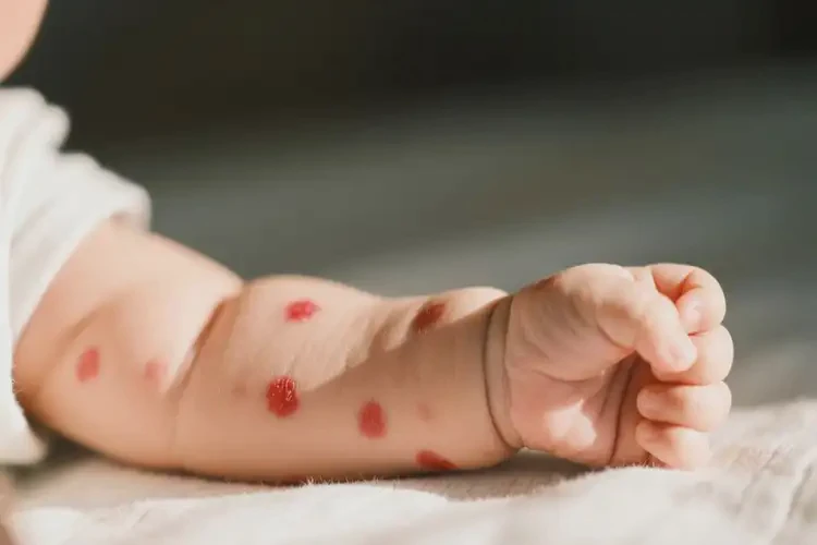 婴儿手臂上起湿疹能治好吗(图3)