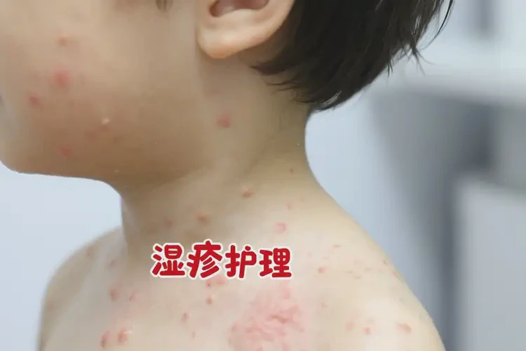 儿童脖子容易长湿疹能治好吗(图3)