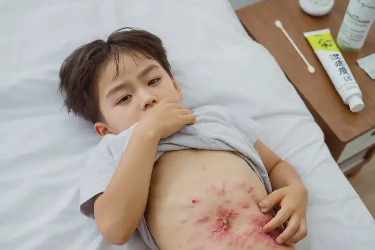 孩子肚子偶尔起湿疹能治好吗(图3)