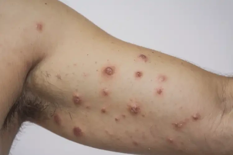 男性手臂上容易长湿疹能治好吗(图3)