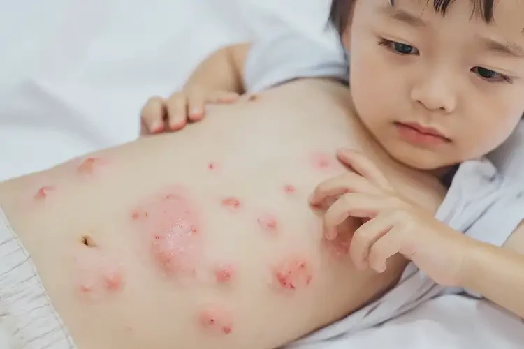 儿童肚子偶尔长湿疹能治好吗(图3)