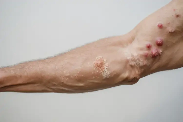 老人四肢容易起湿疹能治好吗(图4)