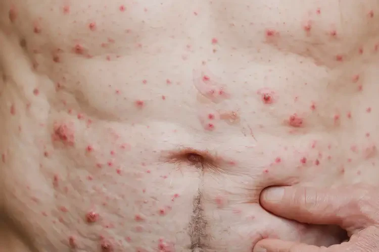 老年人肚子上出湿疹能治好吗(图4)