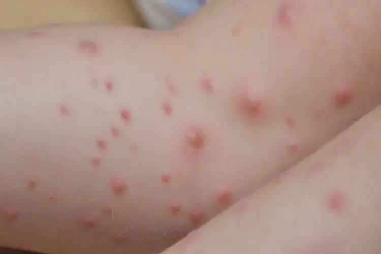 小学生小腿有湿疹能够彻底治愈吗(图4)