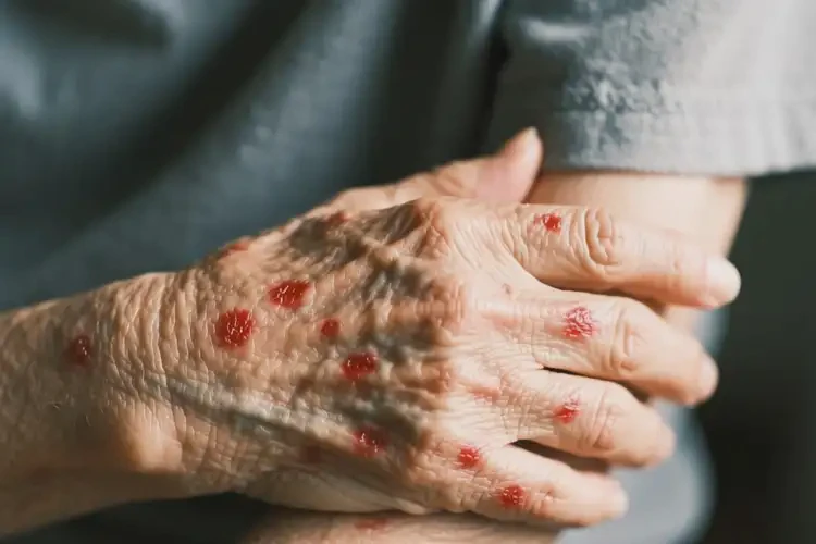 老年人手臂出现湿疹能治好吗(图4)