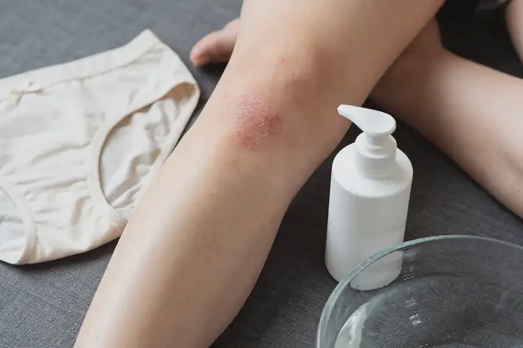 女性大腿有湿疹能治好吗(图2)