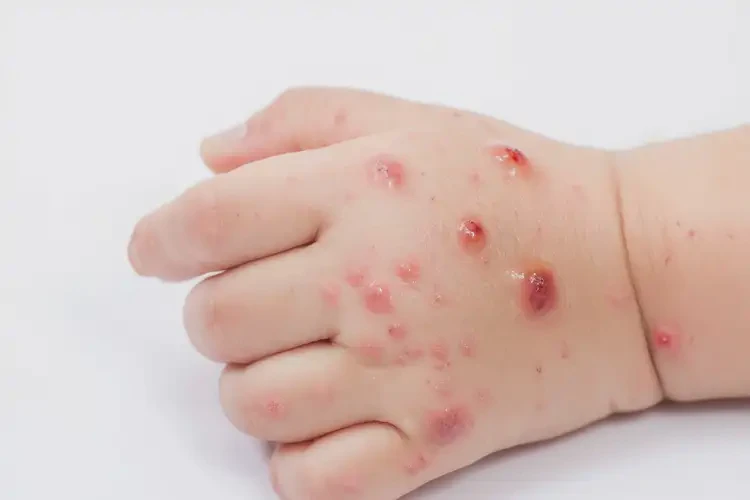 孩子手上长湿疹能治好吗(图2)