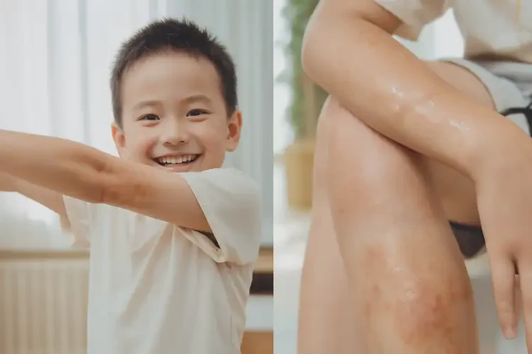 孩子全身容易起湿疹能治好吗(图4)