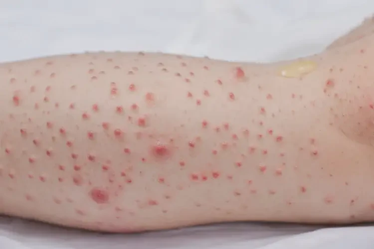 小孩小腿容易起湿疹能治好吗(图3)