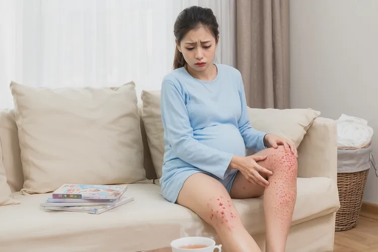 产妇小腿上起湿疹可以治愈吗(图1)