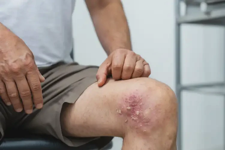 男性大腿上容易起湿疹不管它会自己好吗(图3)