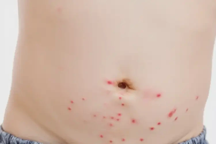 孩子肚子上偶尔起湿疹能治好吗(图4)