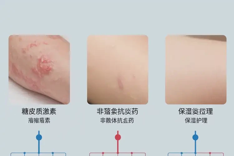 婴幼儿四肢偶尔长湿疹能治好吗(图1)