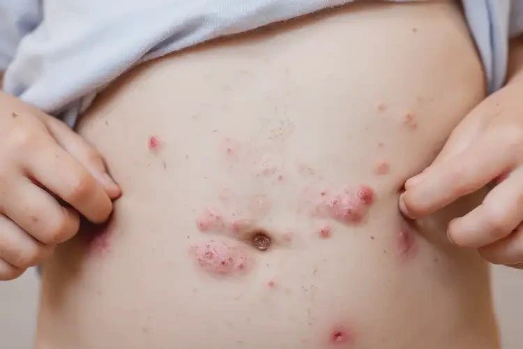 小孩肚子起湿疹能治好吗(图4)