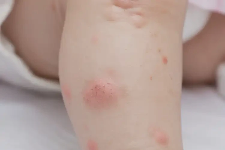 小孩小腿容易起湿疹能治好吗(图4)