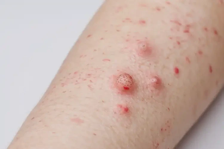 男生屁股上容易起湿疹可不可以彻底自愈(图3)