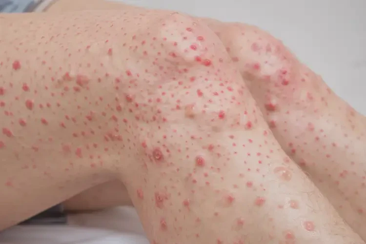 产妇大腿出湿疹能治好吗(图4)